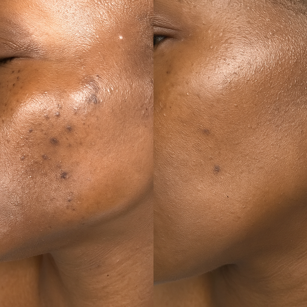 The Hidden Cost of Clear Skin